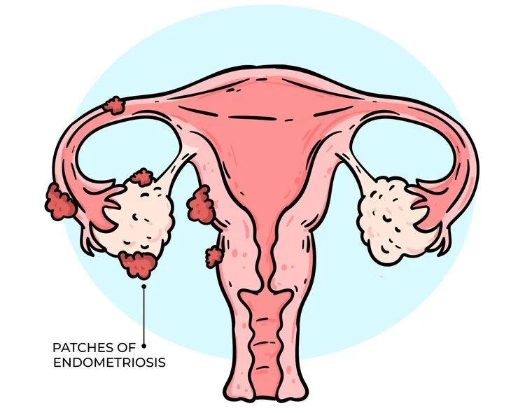 Understanding Endometriosis (Part 2)